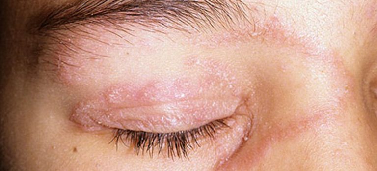 Dry Red Spots On Skin