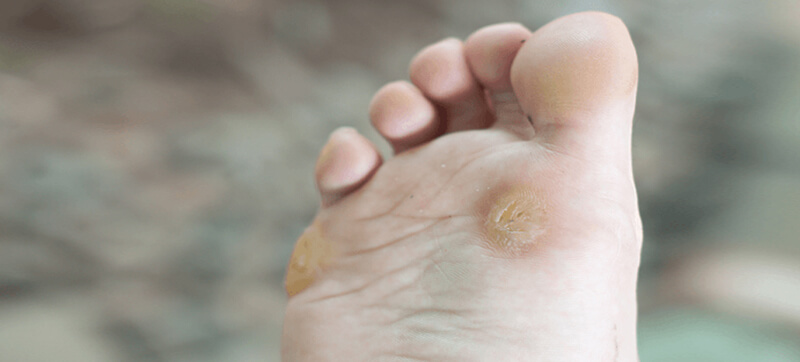 Treating Foot Corns and Warts - Dermatologist In Bangalore
